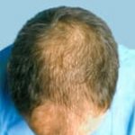 hair transplant surgery before