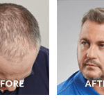 Darren Gough Before After Hair Loss