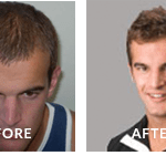 John Jack Anthony Hair Loss Before After