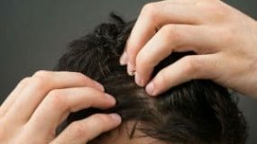Best Hair Loss Treatment