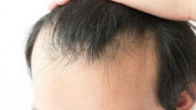 Hair Loss in Men