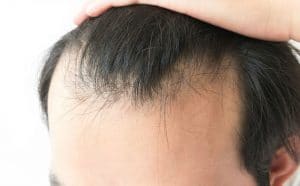 Hair Loss in Men