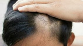 How to Fix Bald Spots