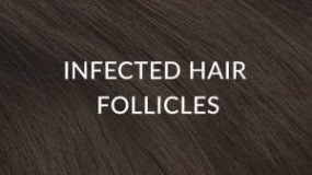 Infected Hair Follicles