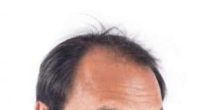 male pattern baldness