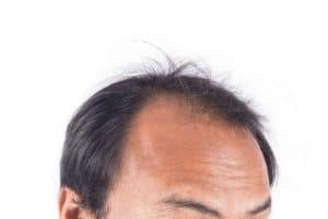 Male Pattern Baldness Treatment - Cure & Stop Hair Loss in Men