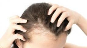 Hair Transplants for Women