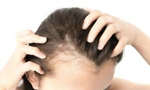 Hair Transplants for Women