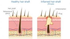 Inflamed Hair Shaft