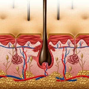 Damaged Hair Follicles