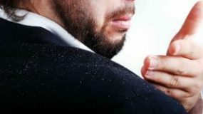 Dandruff And Hair Loss