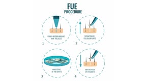 FUE Versus FUT Hair Transplants featured