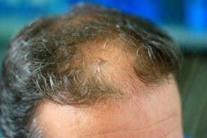 Hair-Implants-Cost-That-Everyone-Can-Afford