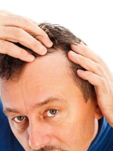 Hair Loss Symtoms - Causes, Signs & Problems of Pattern Baldness