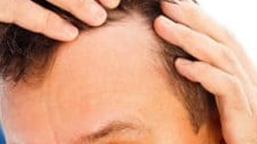 hair-loss-symptoms