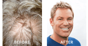 Shane Warne Before After Hair Loss 2