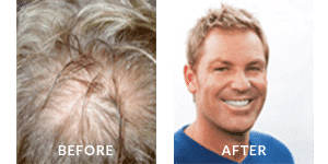 Shane Warne Before After Hair Loss 2