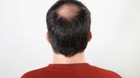 What is A Crown Hair Transplant