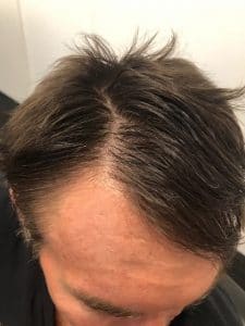 Male Hair Loss Treatment - Client Before & After Pictures
