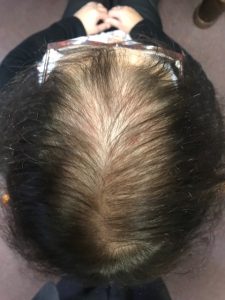 Female Hair Loss After