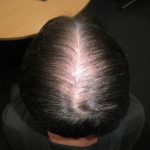 Male hair loss before