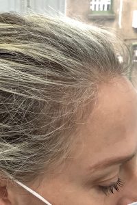 After Woman Hairline