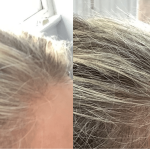 Female results after 4 PRP treatments
