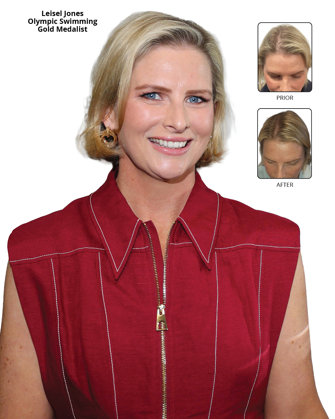 Advanced Hair Leisel Jones Before And After Advanced Hair Leisel Jones Before And After