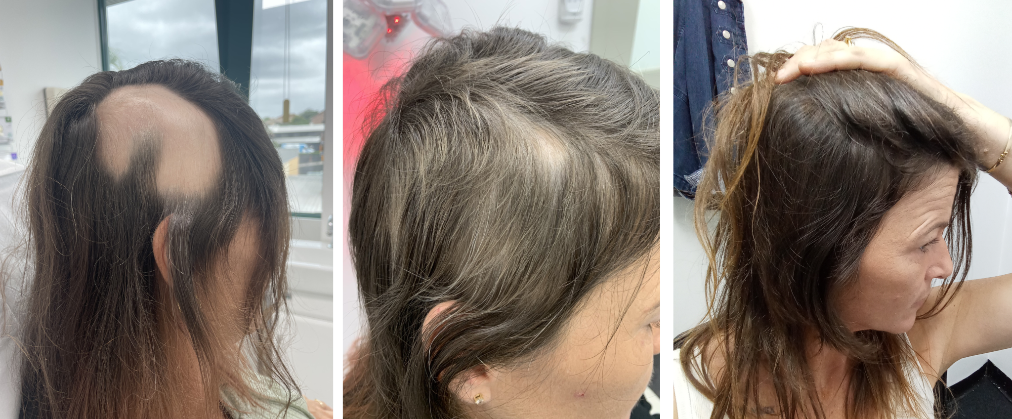 Advanced Hair Stem Cell Infused PRP Plus PRP and Advanced Laser Therapy Advanced Hair Stem Cell Infused PRP Plus PRP and Advanced Laser Therapy